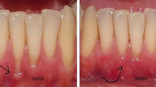 Diş Eti Çekilmesinin Nedenleri 