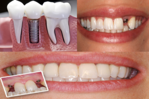 implant diş