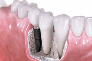 implant tedavisi